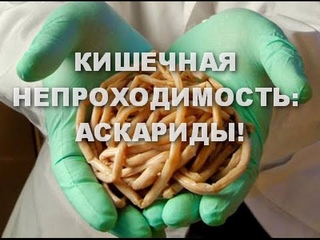 Кишечная непроходимость. Аскариды