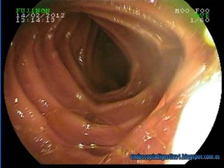 Double balloon enteroscopy micropolyps of small intestine2